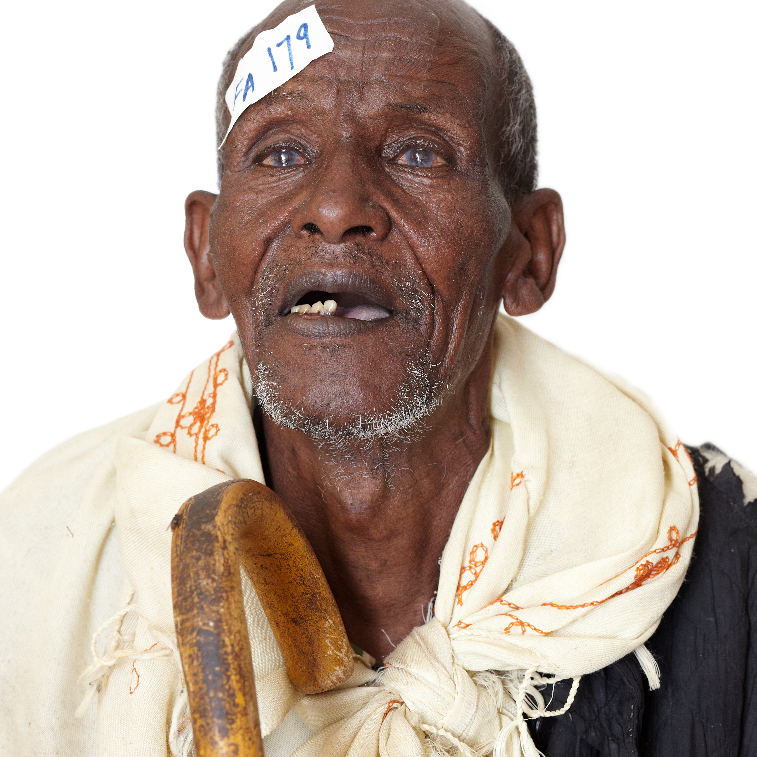 Ethiopia portrait cataract surgery.